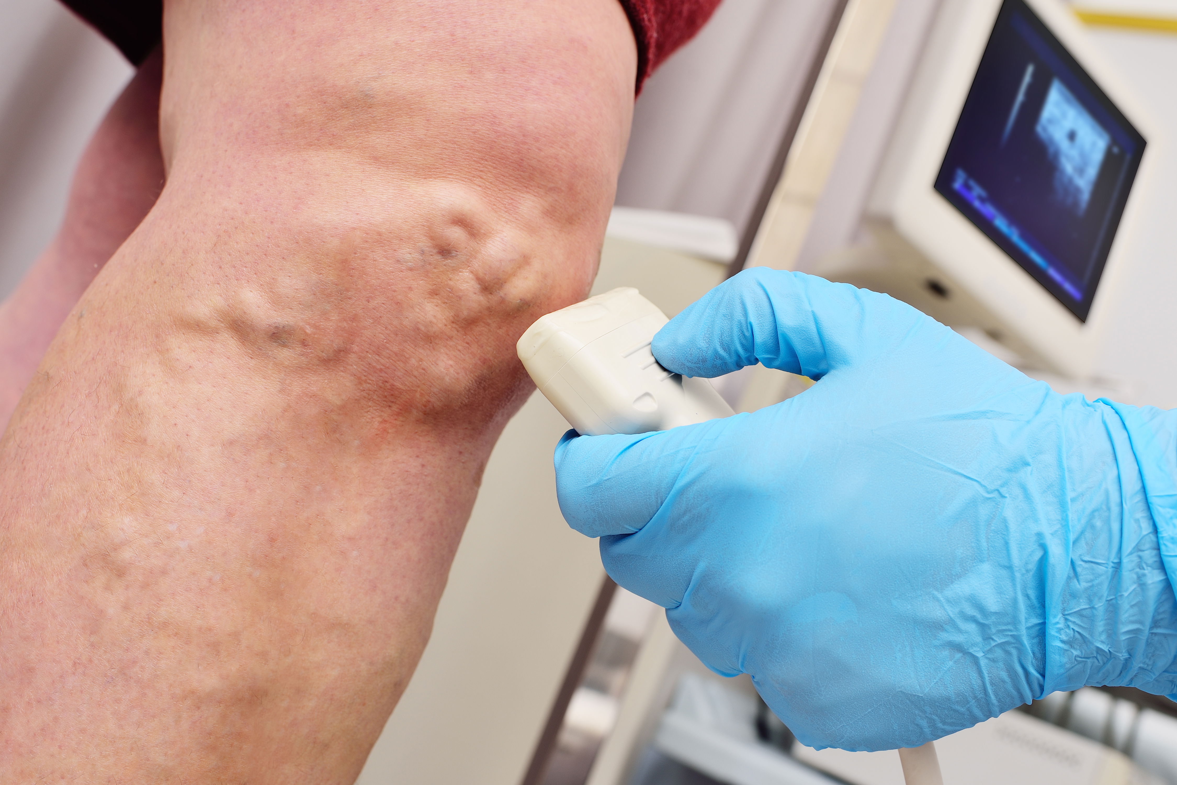 Arzt untersucht eine Seitenastvarikose am Knie, mithilfe von Ultraschall.