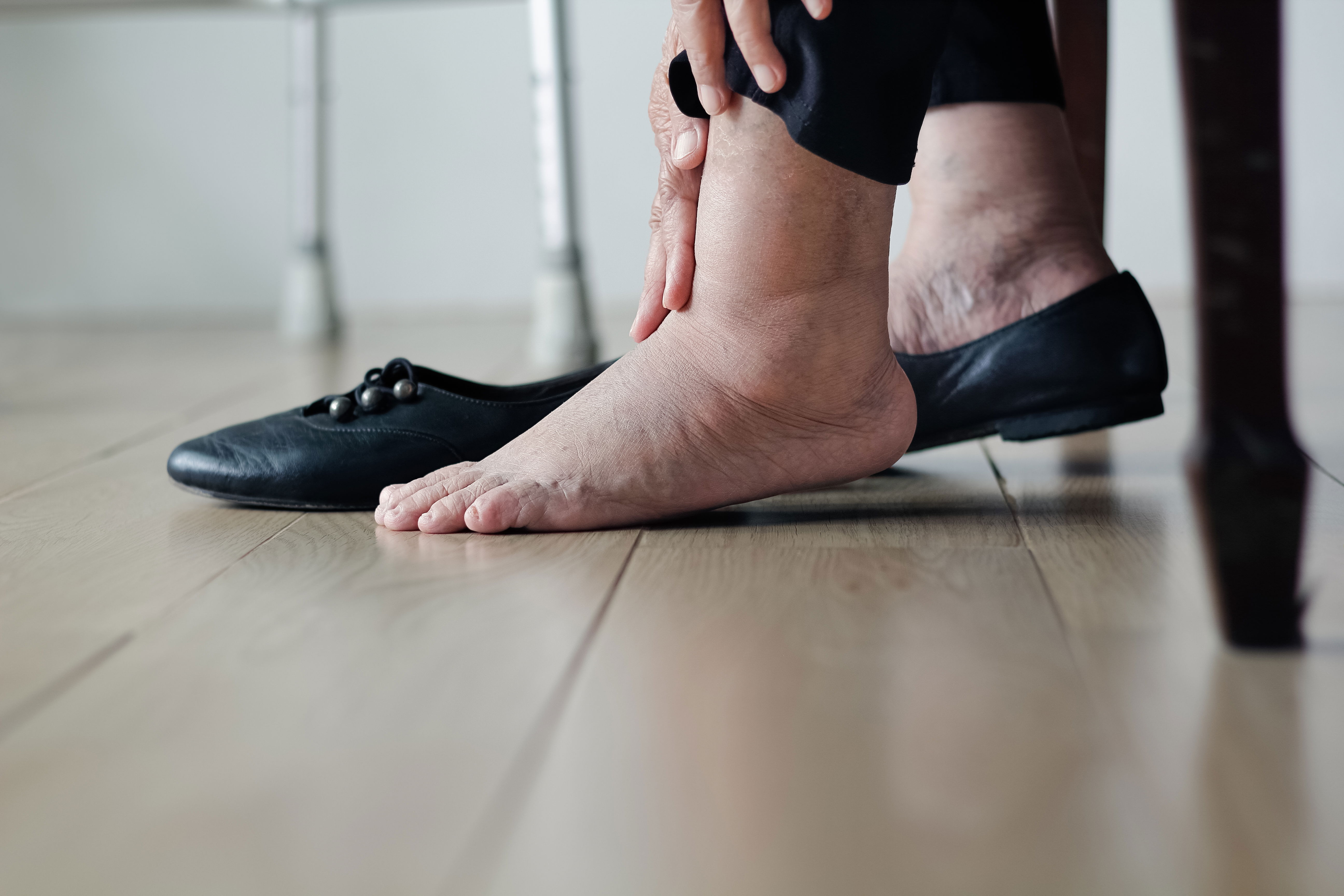 Nahaufnahme der Füße einer Frau, die sich die Schuhe auszieht, wodurch die Schwellungen infolge von Ödemen an den Fußgelenken sichtbar werden.